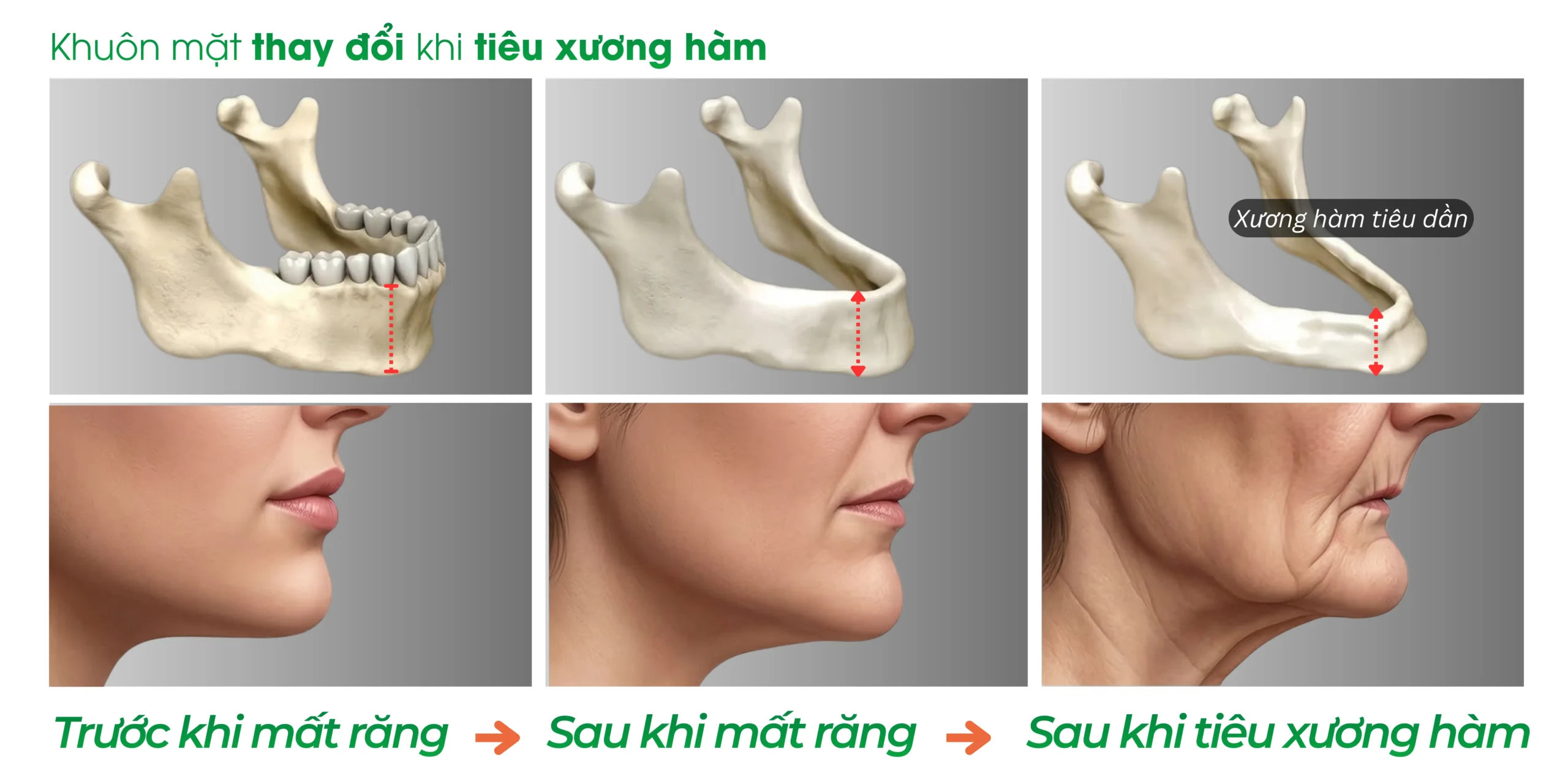 mất răng lâu năm