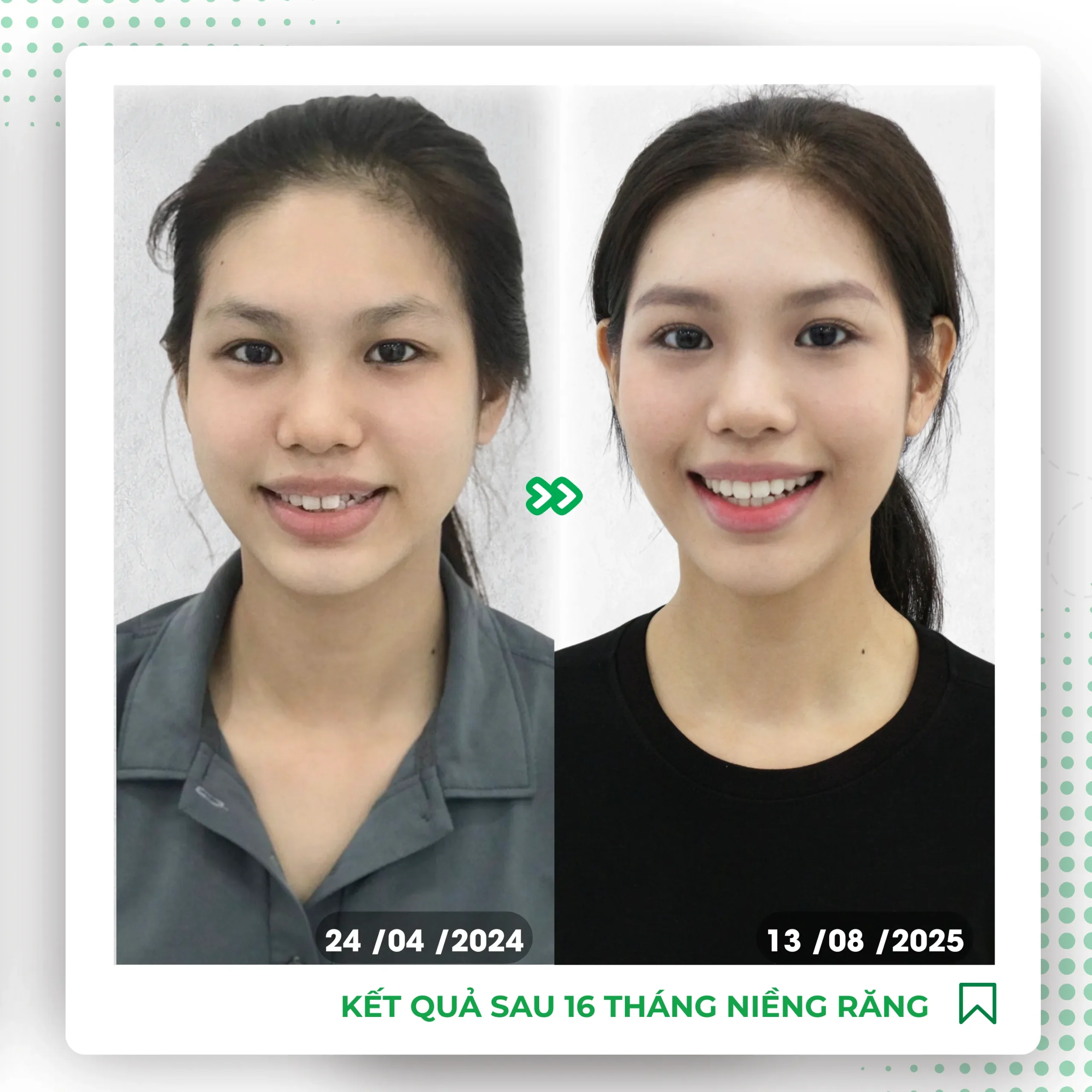  thời gian niềng răng 