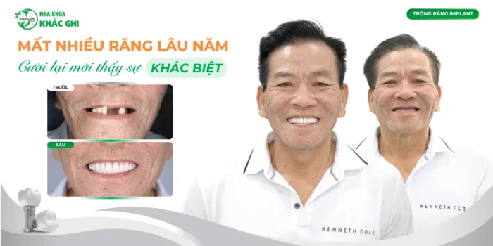 Trồng răng implant