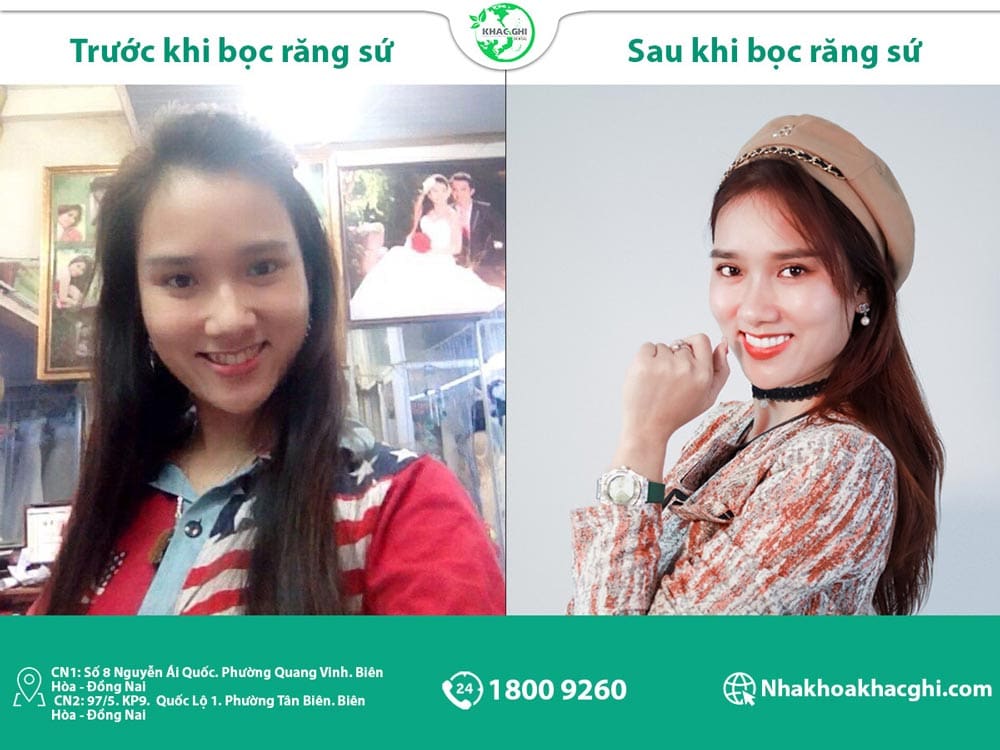 Trước và sau khi bọc răng sứ tại Khắc Ghi