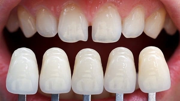 Có nên bọc sứ 6 răng cửa không và những điều cần biết