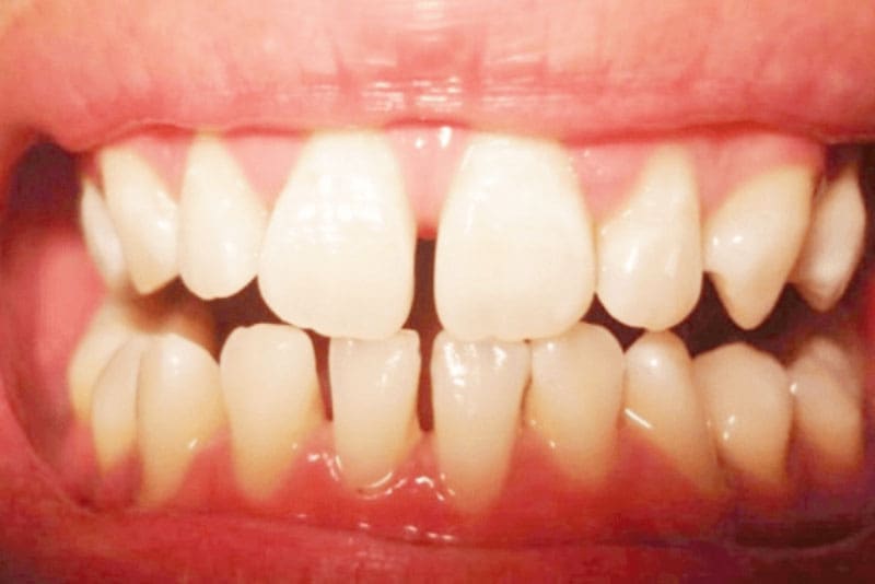 bọc sứ răng thưa bao nhiêu tiền