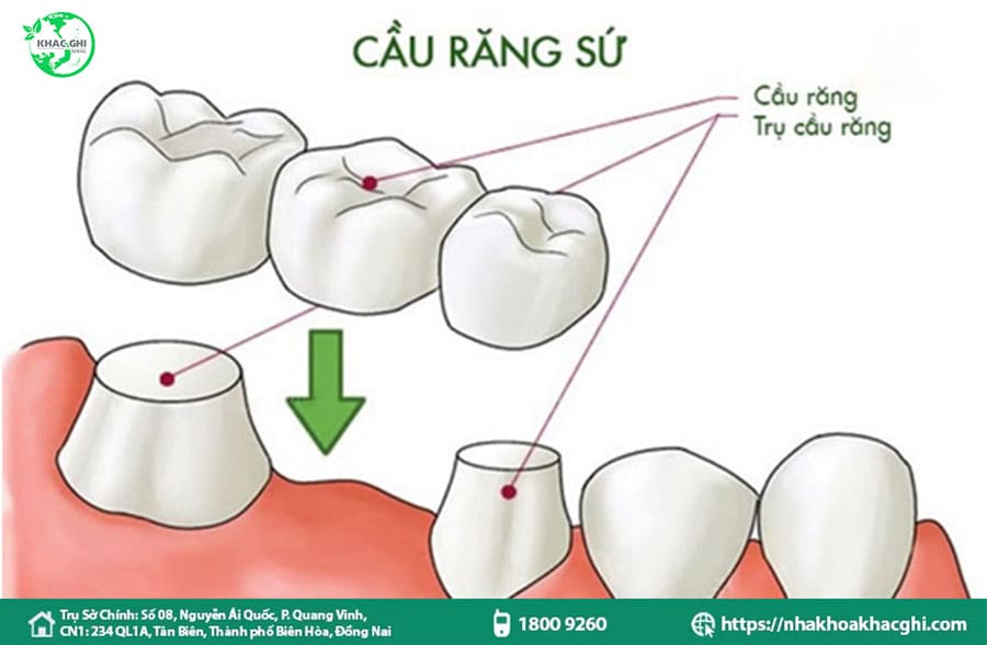 Bọc răng sứ thẩm mỹ là gì? Quy trình và bảng giá chi tiết 29 Cầu răng sứ - nha khoa khắc ghi