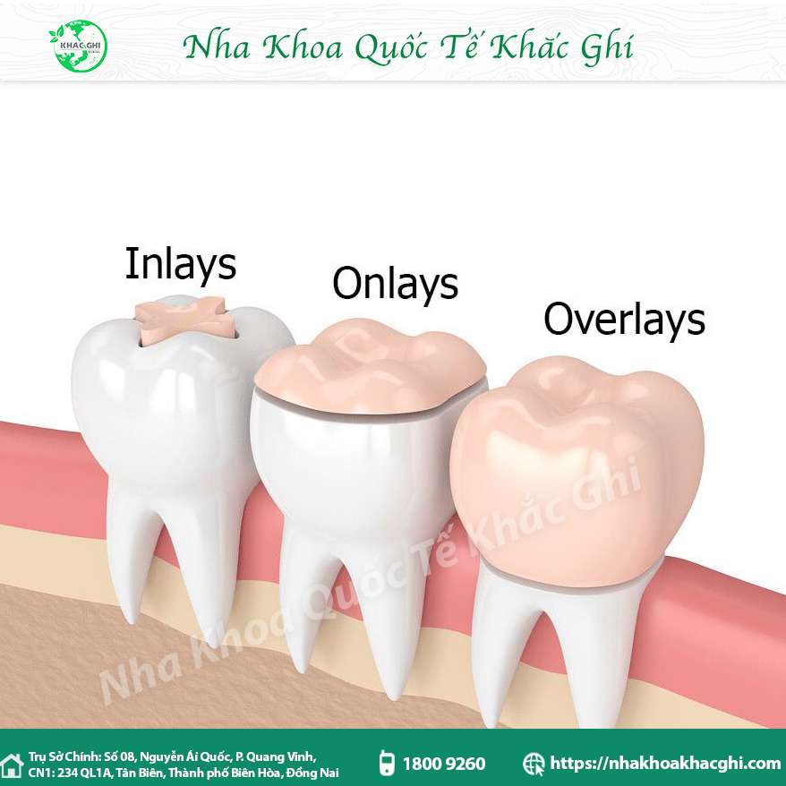 Bọc răng sứ thẩm mỹ là gì? Quy trình và bảng giá chi tiết 30 Trám răng sứ inlay, outlay, overlay nha khoa khắc ghi
