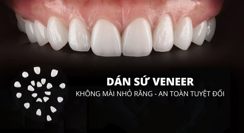 Bọc răng sứ thẩm mỹ là gì? Quy trình và bảng giá chi tiết 31 Dán sứ veneer tại nha khoa khắc ghi