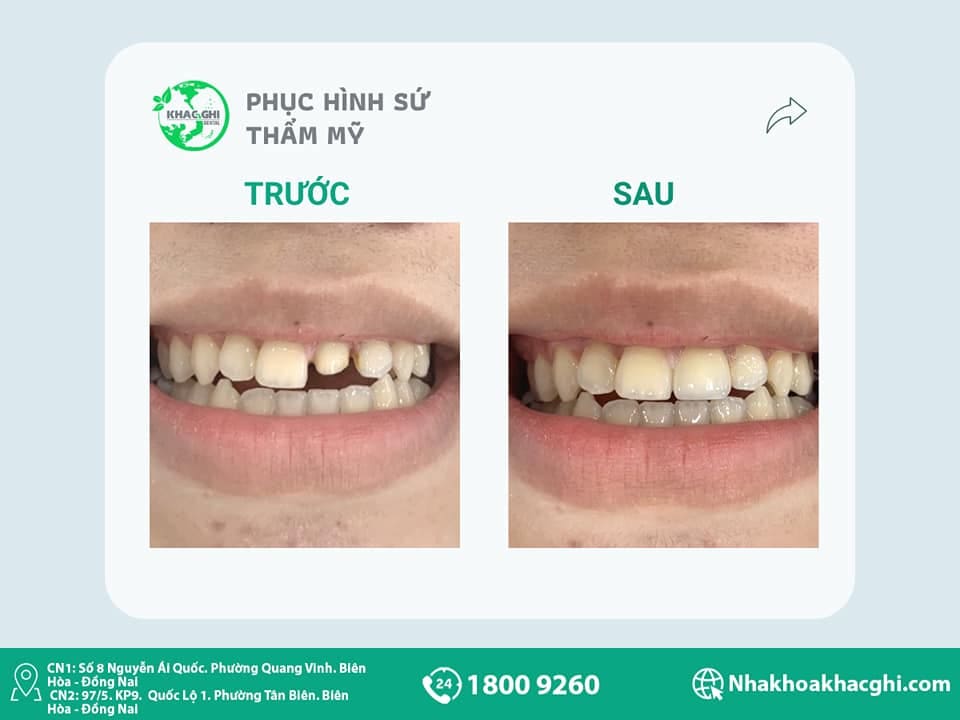 Bọc răng sứ thẩm mỹ là gì? Quy trình và bảng giá chi tiết 37 Khi nào nên bọc sứ răng cửa?