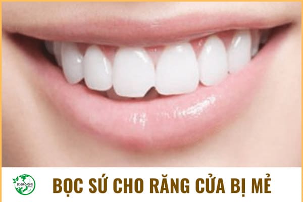 Bọc răng sứ thẩm mỹ là gì? Quy trình và bảng giá chi tiết 25 boc-rang-su-cho-rang-cua-bi-me