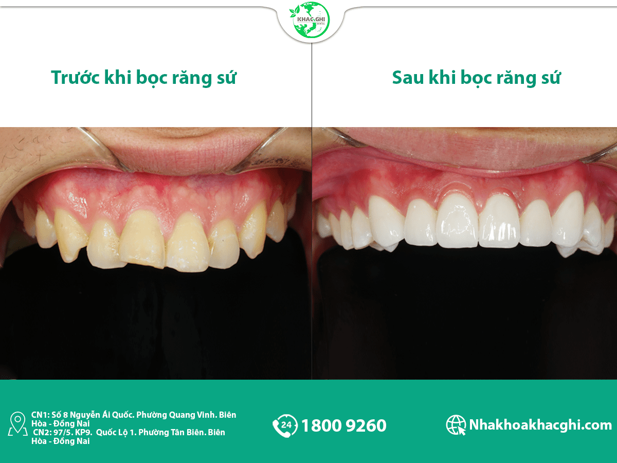 Bọc răng sứ vĩnh viễn được không ? Yếu tố ảnh hưởng đến bọc răng sứ