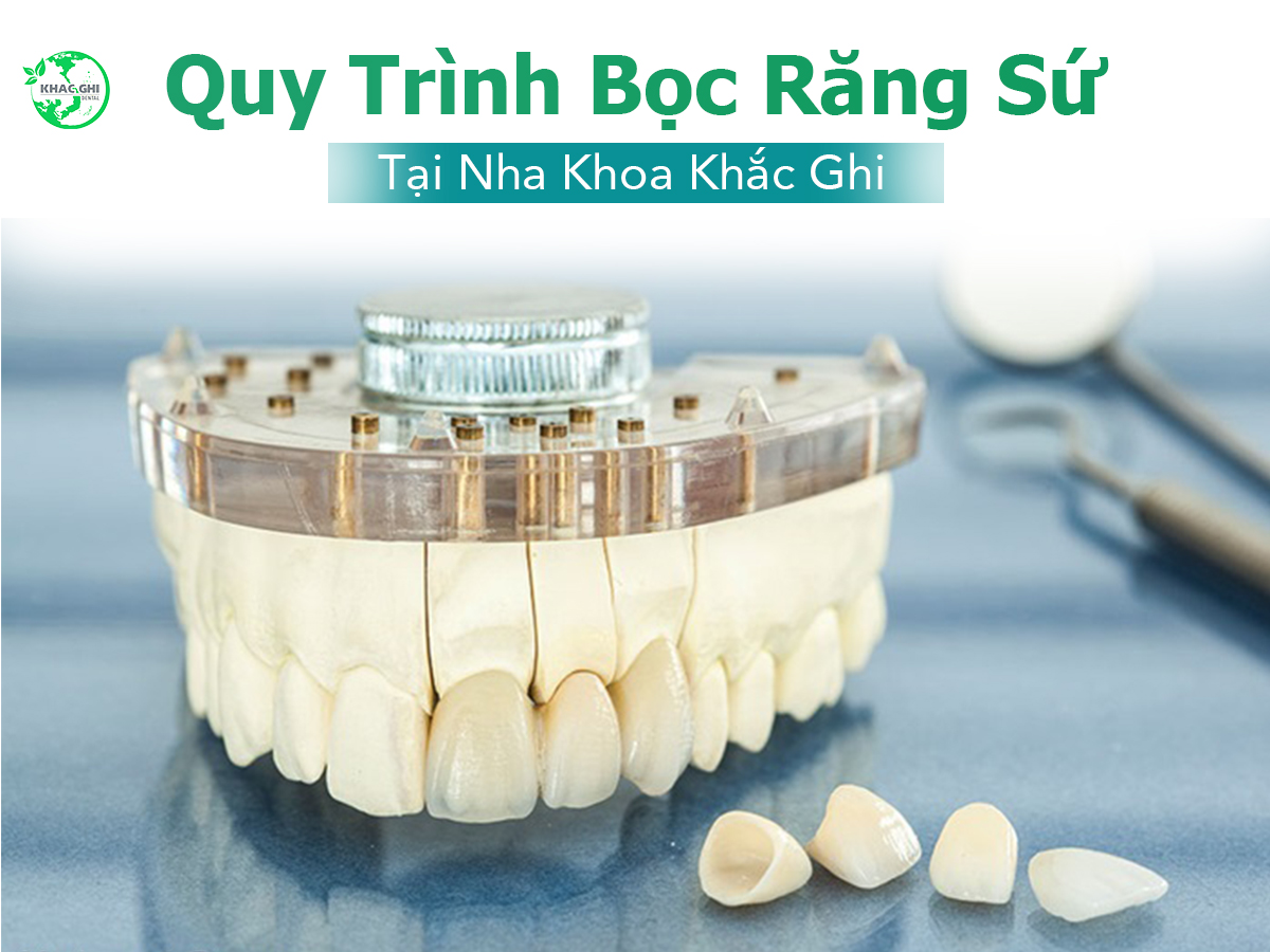 Quy trình bọc răng sứ thẩm mỹ tại nha khoa khắc ghi