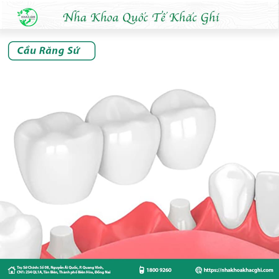 Cầu răng sứ là gì ? Làm cầu răng sứ có bền không ? 4 Làm cầu răng sứ có đau không ? Sử dụng có bền không?