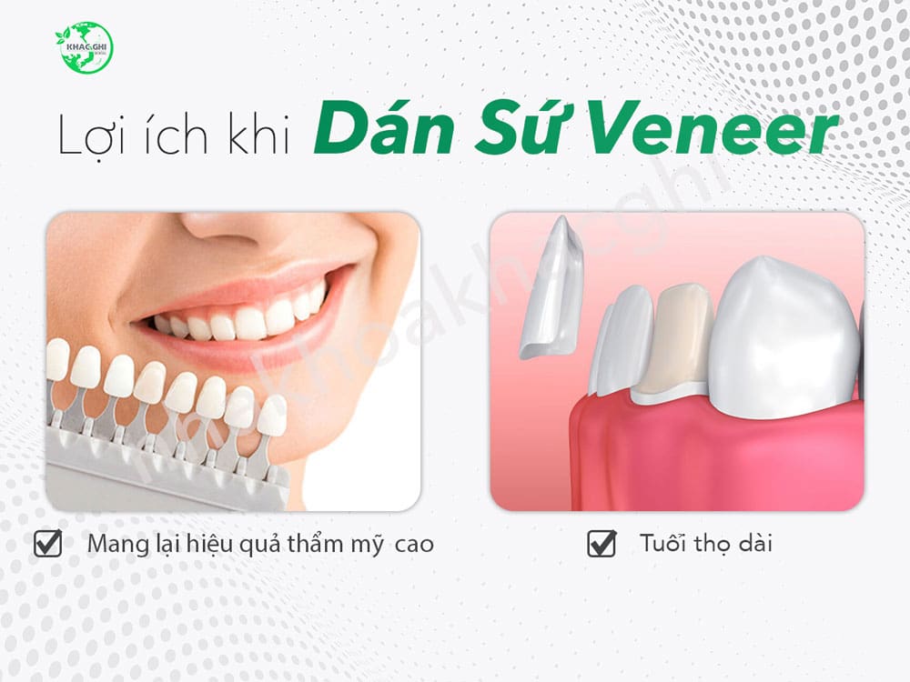 lợi ích mặt dán sứ veneer nha khoa khắc ghi