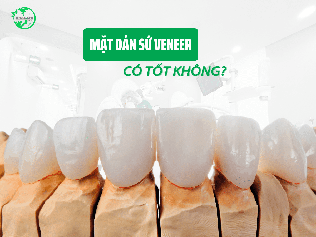 dan su veneer co tot khong truong hop nao nen dan su veneer 1