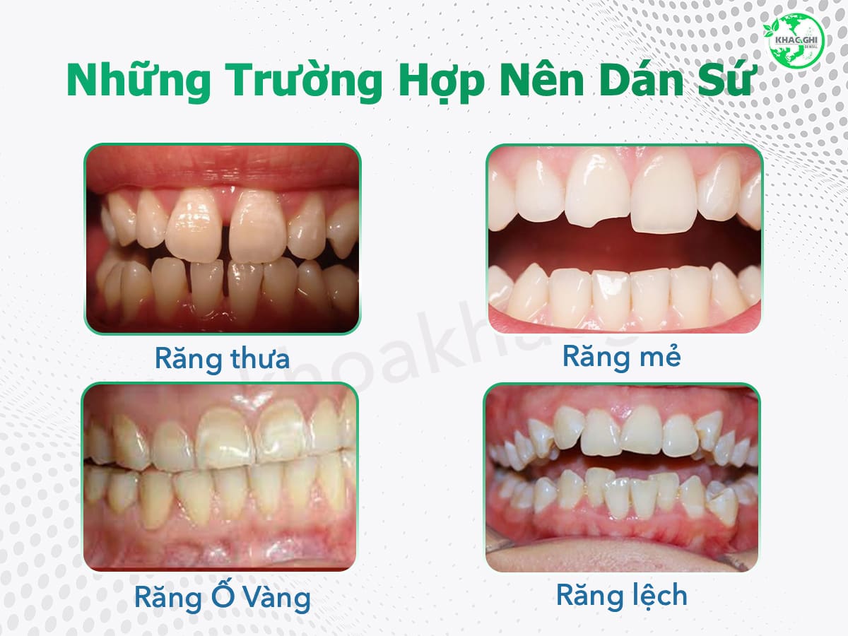 Những trường hợp nên dán sứ veneer
