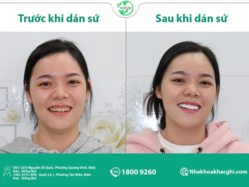 Khách hàng dán sứ Veneer tại Khắc Ghi