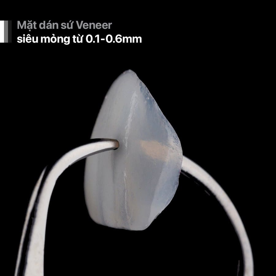 dan su veneer co tot khong truong hop nao nen dan su veneer 4