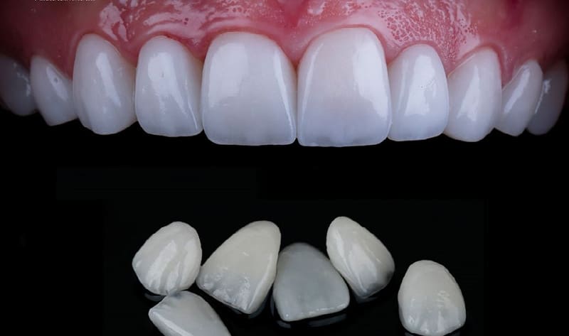 dan su veneer co tot khong truong hop nao nen dan su veneer 6