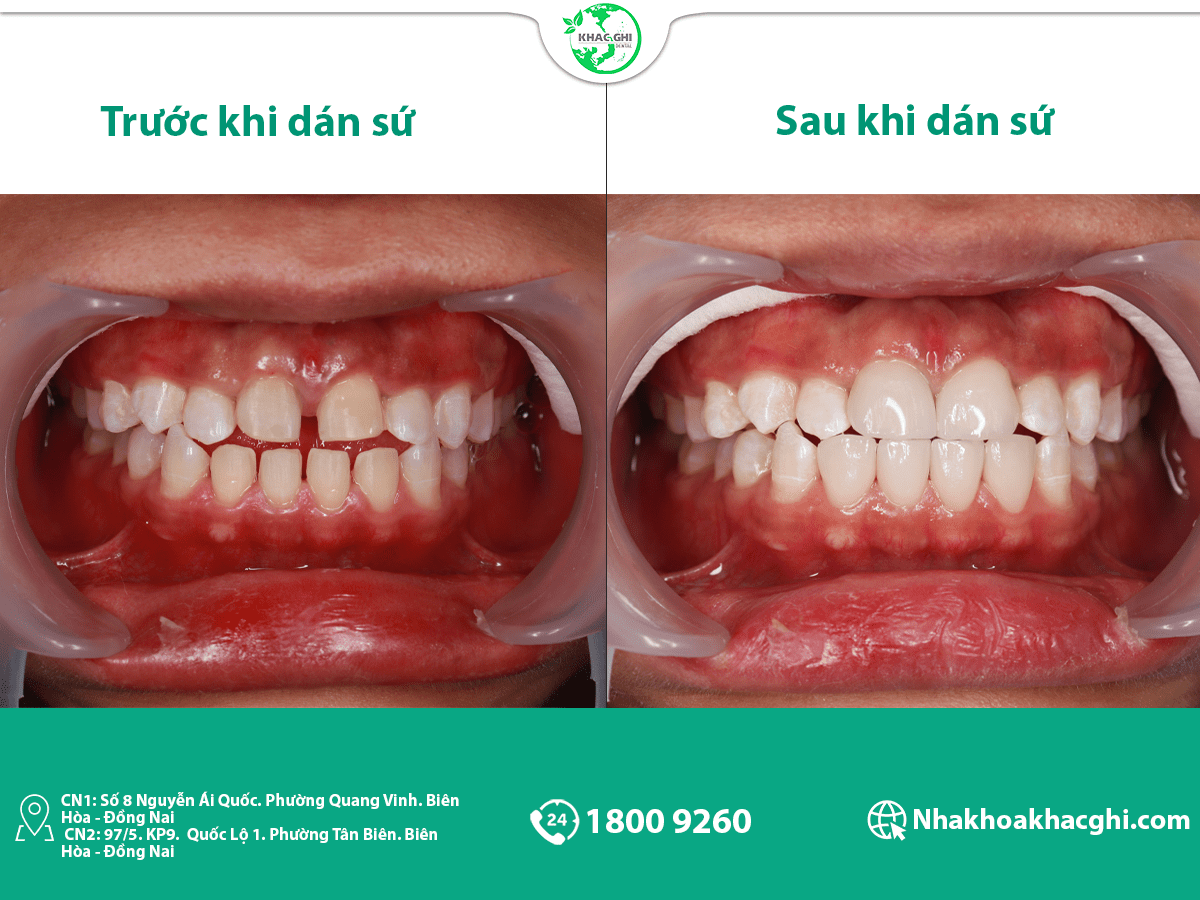 Ảnh trước sau khi dán sứ veneer của khách hàng tại nha khoa khắc ghi
