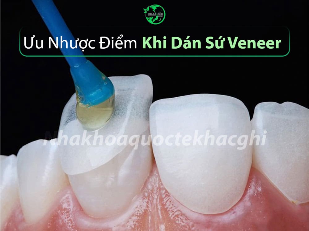 Ưu nhược điểm dán sứ veneer