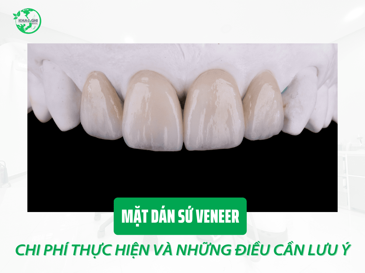 Chi phí dán sứ veneer và những điều cần biết