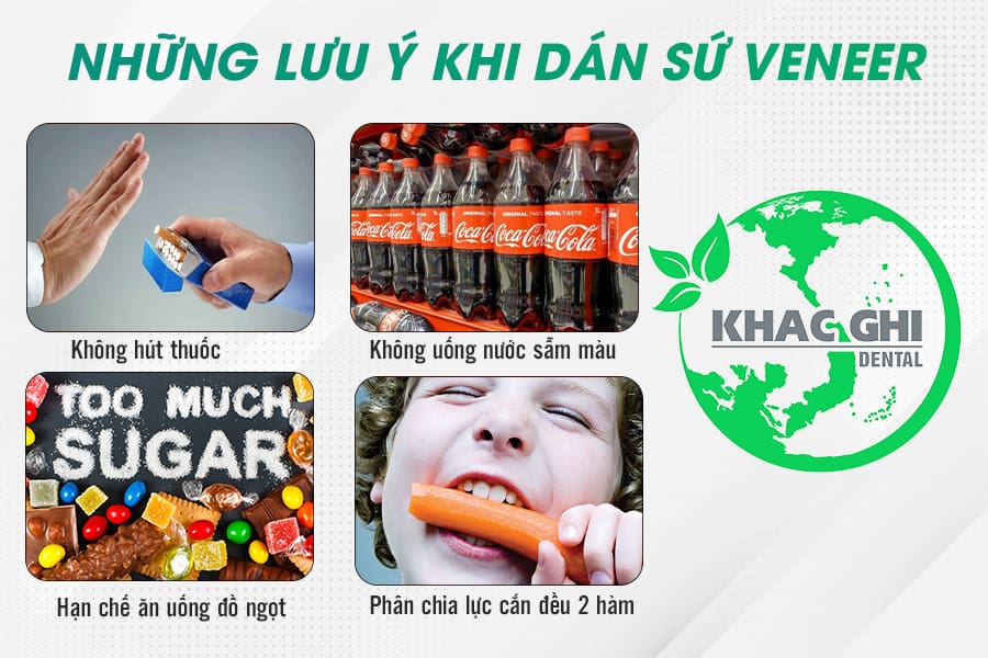 những lưu ý khi dán sứ veneer