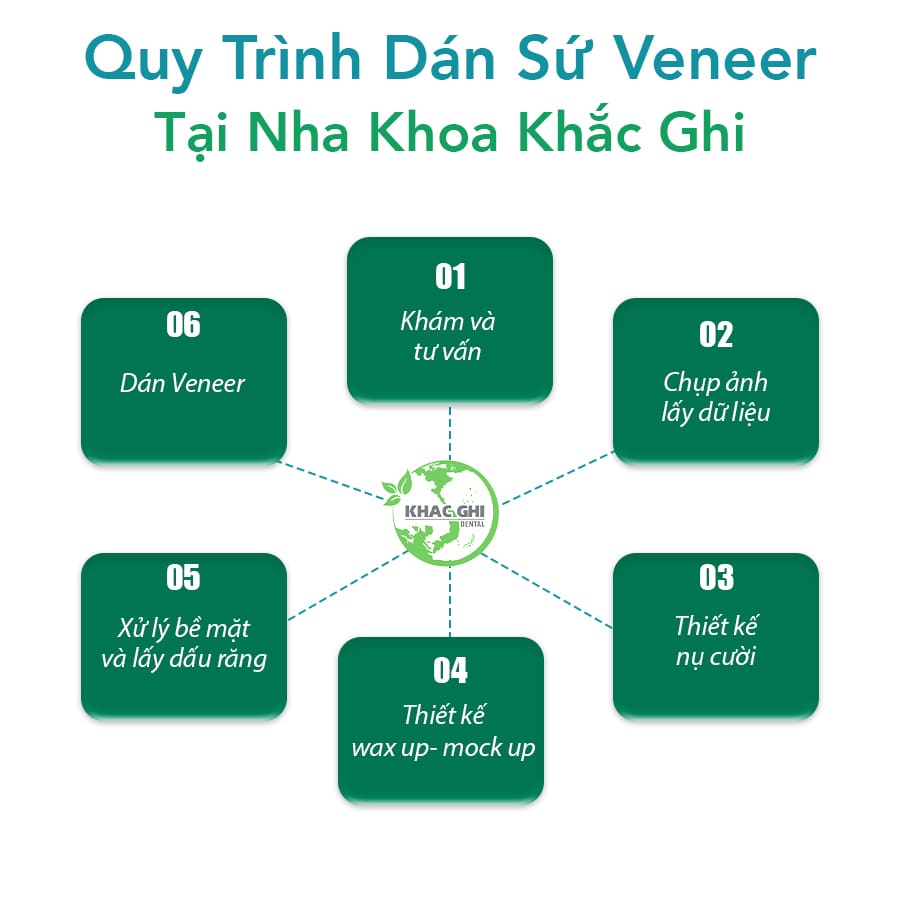 Quy trình dán sứ veneer tại Nha Khoa Khắc Ghi
