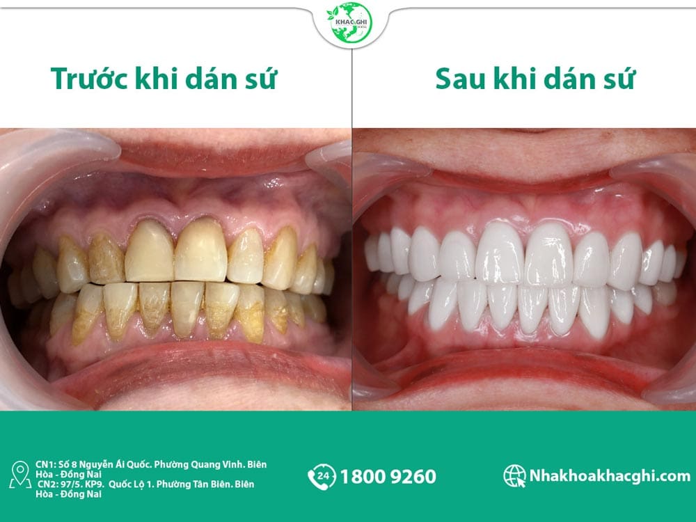 Ảnh trước sau khi dán sứ veneer của khách hàng tại nha khoa khắc ghi