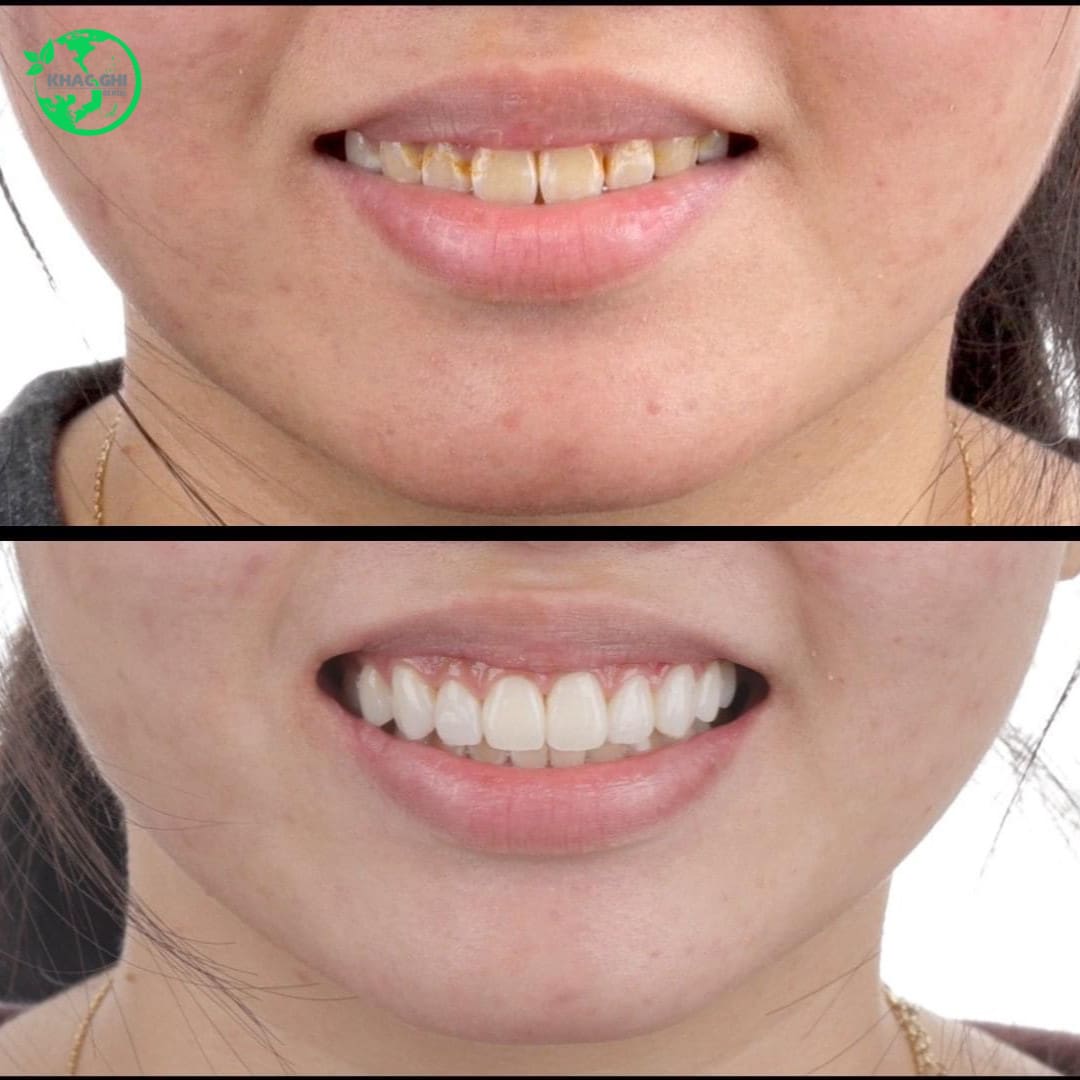 review dán sứ veneer tại nha khoa khắc ghi