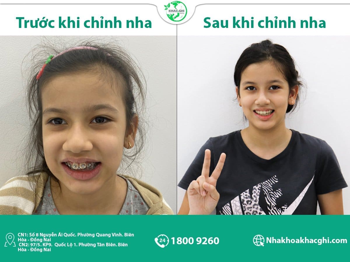 Sự Kiện Khai Trương Nha Khoa Khắc Ghi Hố Nai (2022) 16 giam gia cuc lon mung khai truong chi nhanh ho nai 7