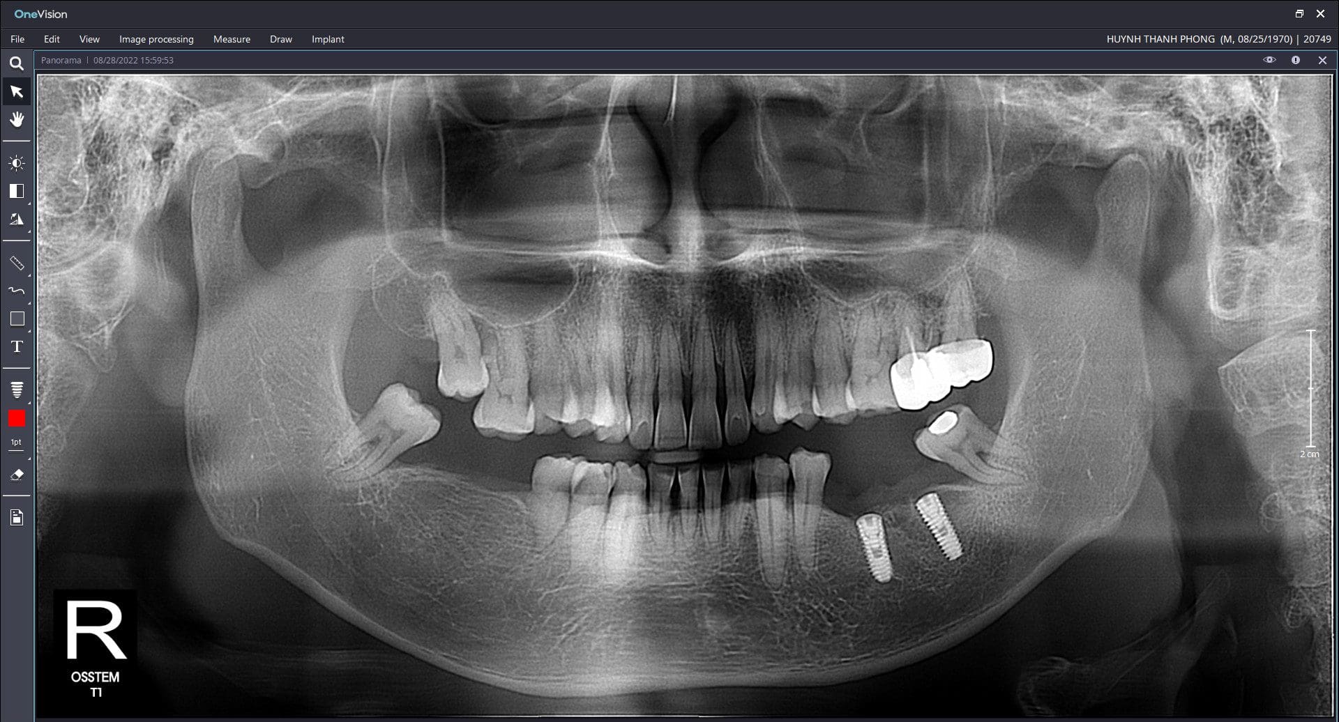may chup ct cone beam 3d cong nghe nha khoa dot pha 2