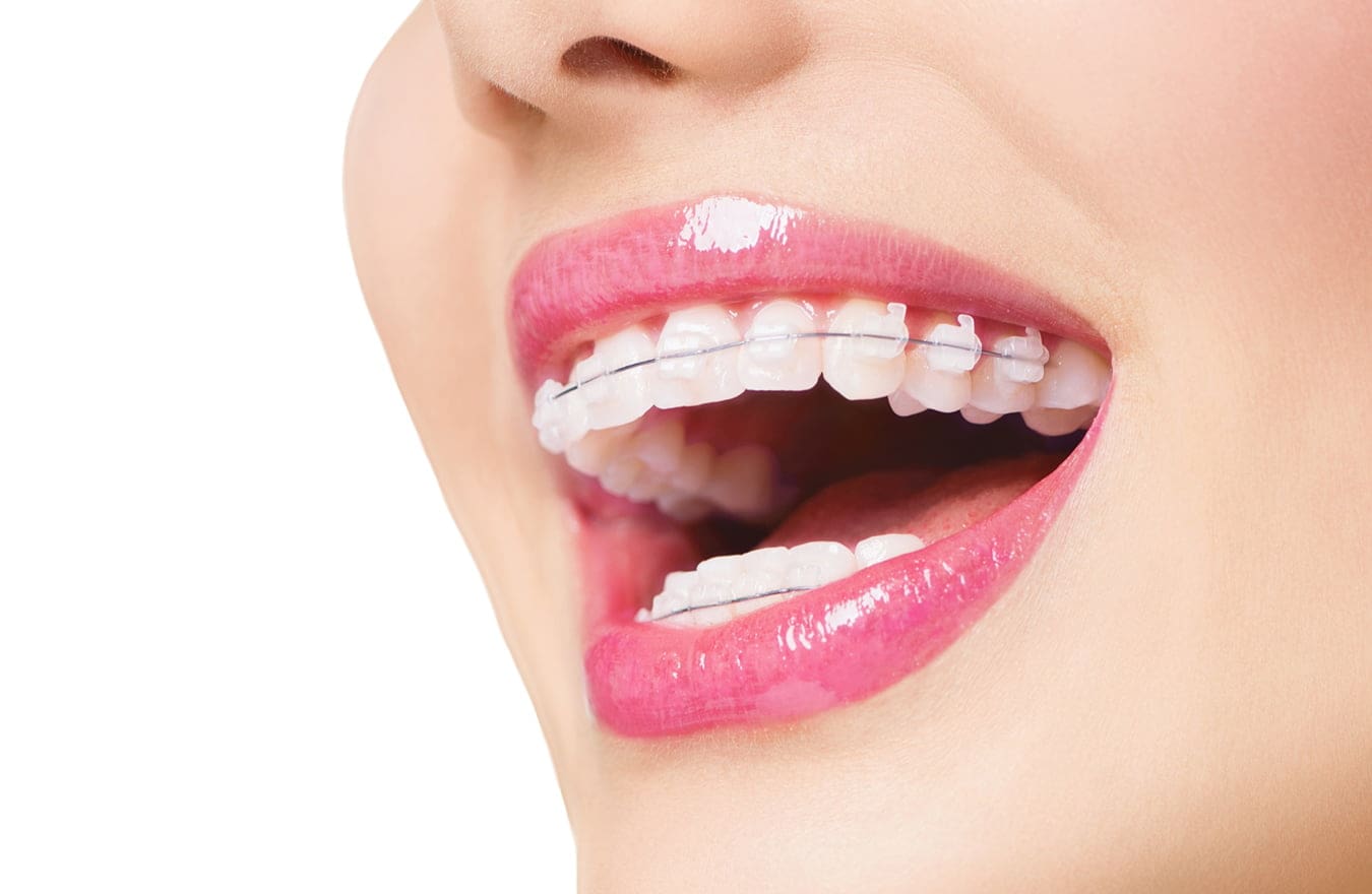 Nên chọn niềng răng trong suốt hay niềng răng mắc cài? 10 nen chon nieng rang trong suot hay nieng rang mac cai 3