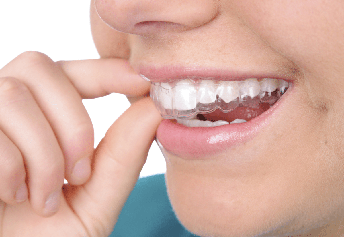 Nên chọn niềng răng trong suốt hay niềng răng mắc cài? 11 Niềng răng trong suốt trả góp