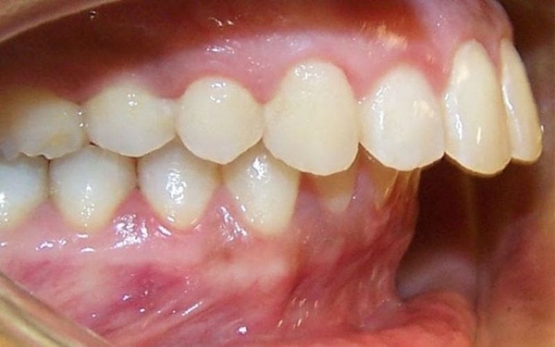 Răng Hô: Nguyên Nhân, Các Kiểu Hô & 3 Cách Khắc Phục Hiệu Quả 9 nhung bat loi cua rang ho va phuong phap khac phuc 2