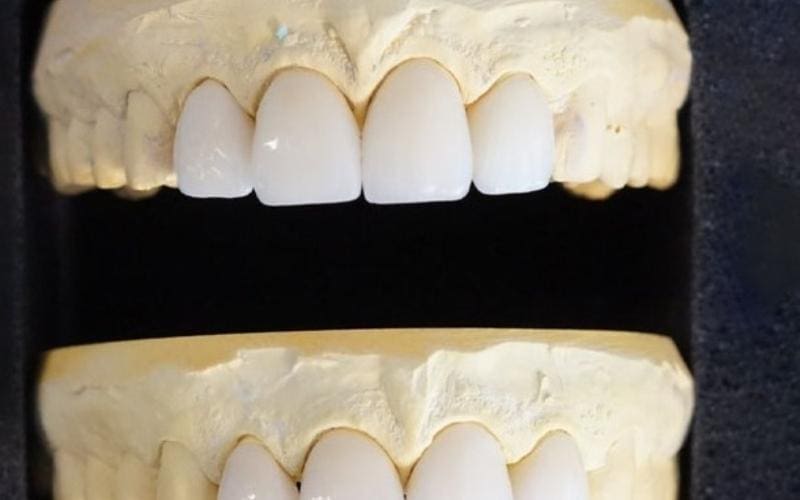 Những điều cần biết khi bọc răng sứ 4 răng cửa