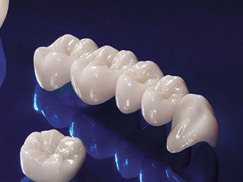 Những điều cần biết khi bọc răng sứ 4 răng cửa