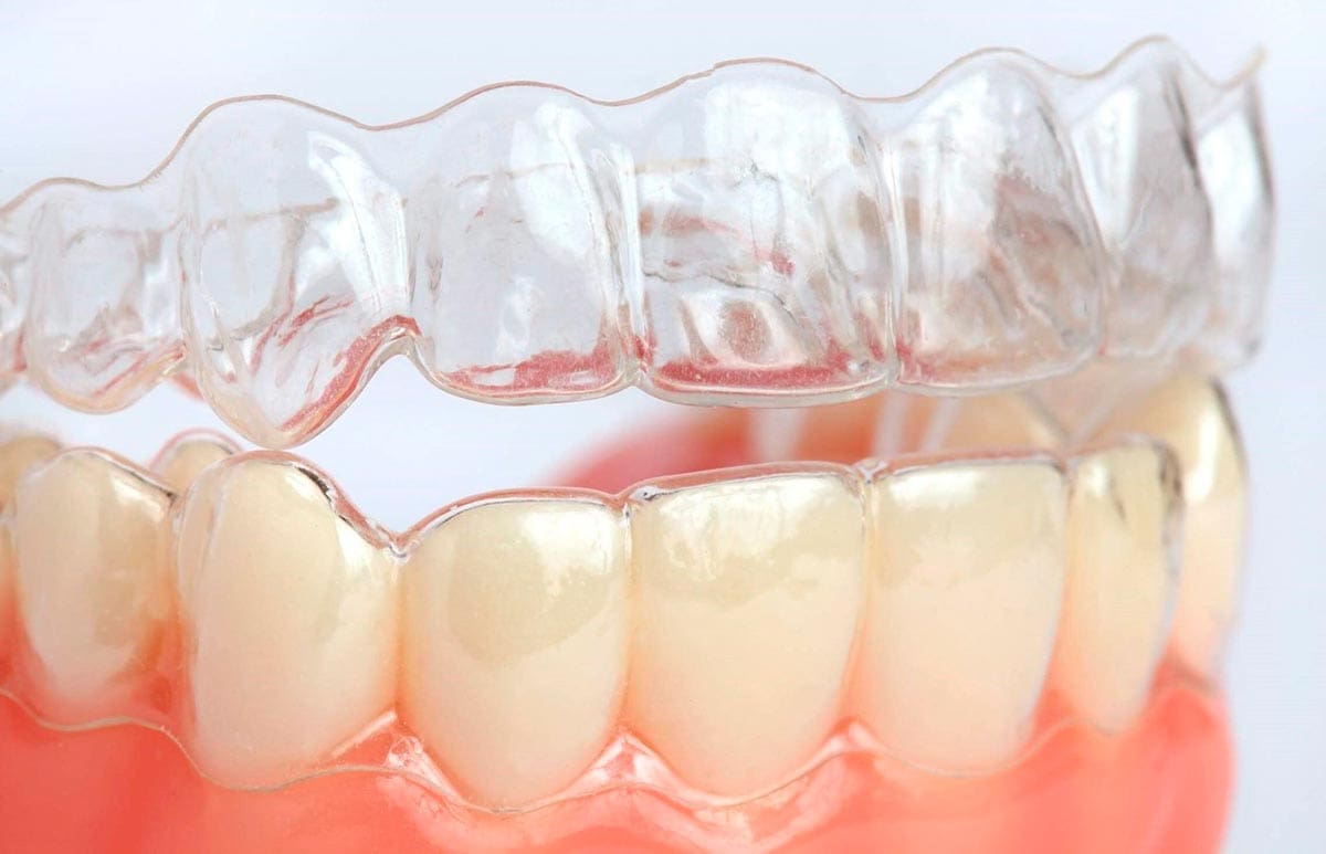 Niềng răng trong suốt bao lâu thì hiệu quả