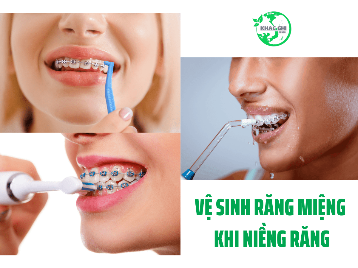 Vệ sinh răng miệng sau khi niềng răng như nào mới đúng cách