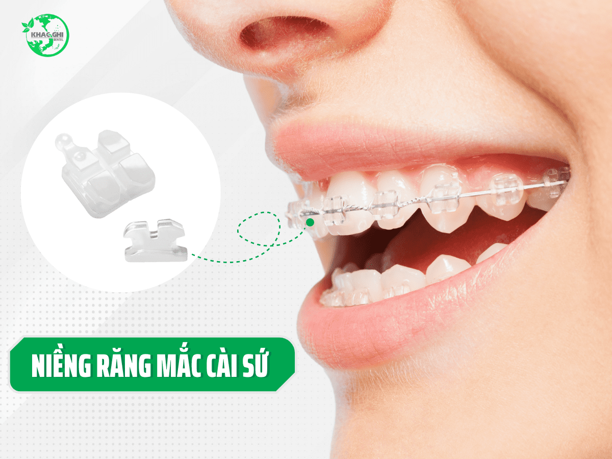 Niềng răng mắc cài sứ và những điều cần biết 9 nieng rang mac cai su va nhung dieu can biet nha khoa khac ghi 1
