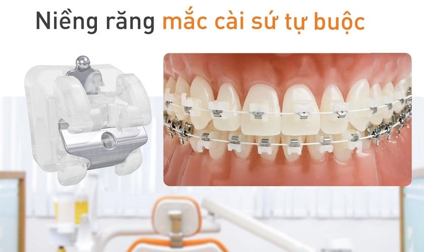 Niềng răng mắc cài sứ và những điều cần biết 12 niềng răng mắc cài sứ tự buộc - nha khoa khắc ghi