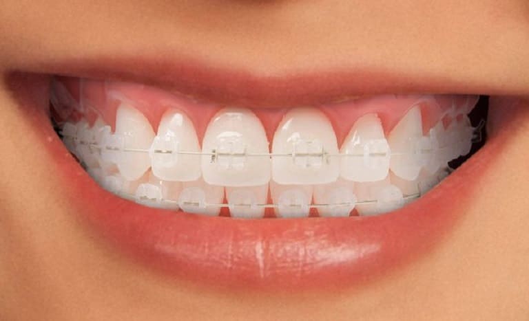 Niềng răng mắc cài sứ và những điều cần biết 14 niềng răng mắc cài sứ - nha khoa khắc ghi