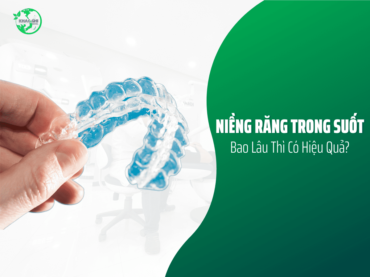 Niềng răng trong suốt bao lâu thì có hiệu quả? 8 nieng rang trong suot bao lau thi co hieu qua 1