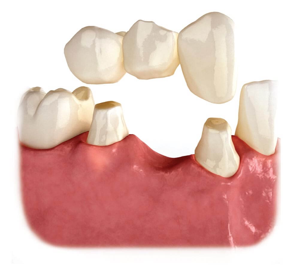 Quy Trình Làm Cầu Răng Sứ Chi Tiết Qua 5 Bước Chuẩn Y Khoa 11 có nên cấy ghép implant