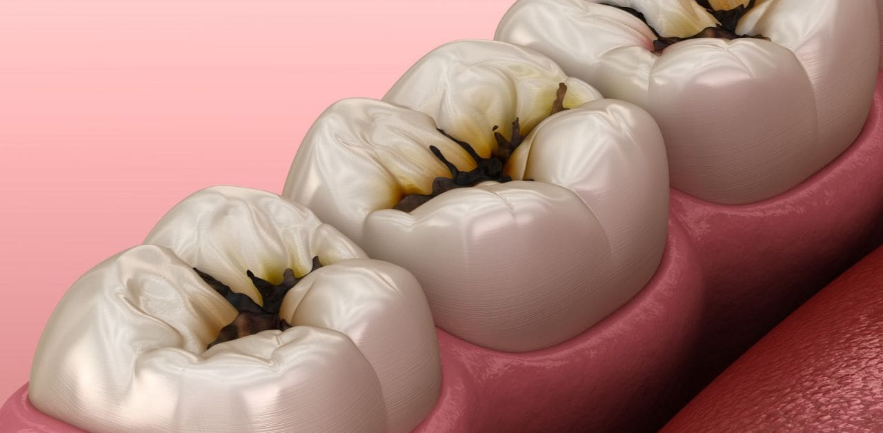 Răng bị sâu 11 rang bi sau 1