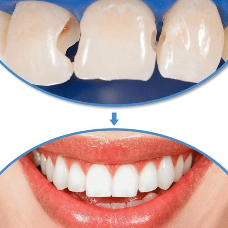 Răng bị sâu 12 Phương pháp bọc sứ cho răng bị sâu