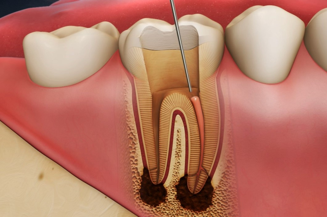 Răng bị sâu 14 rang bi sau 4