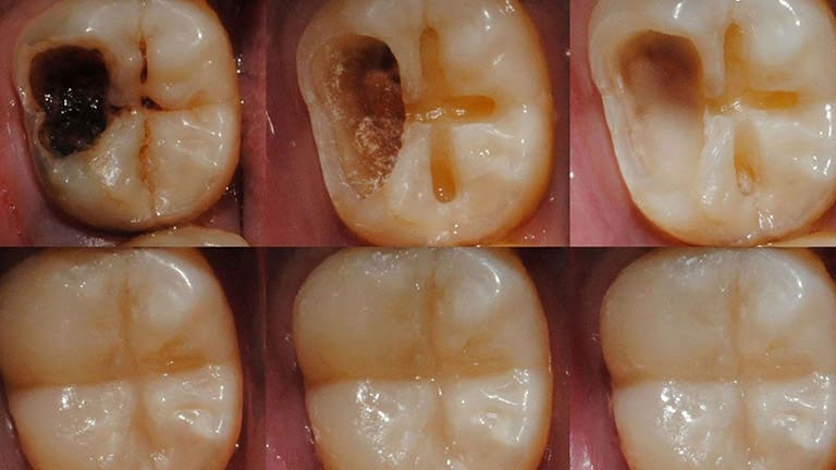 Răng bị sâu 15 rang bi sau 5