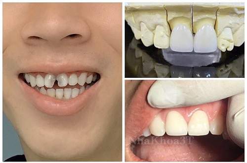 Bọc sứ cho răng cửa bị sâu
