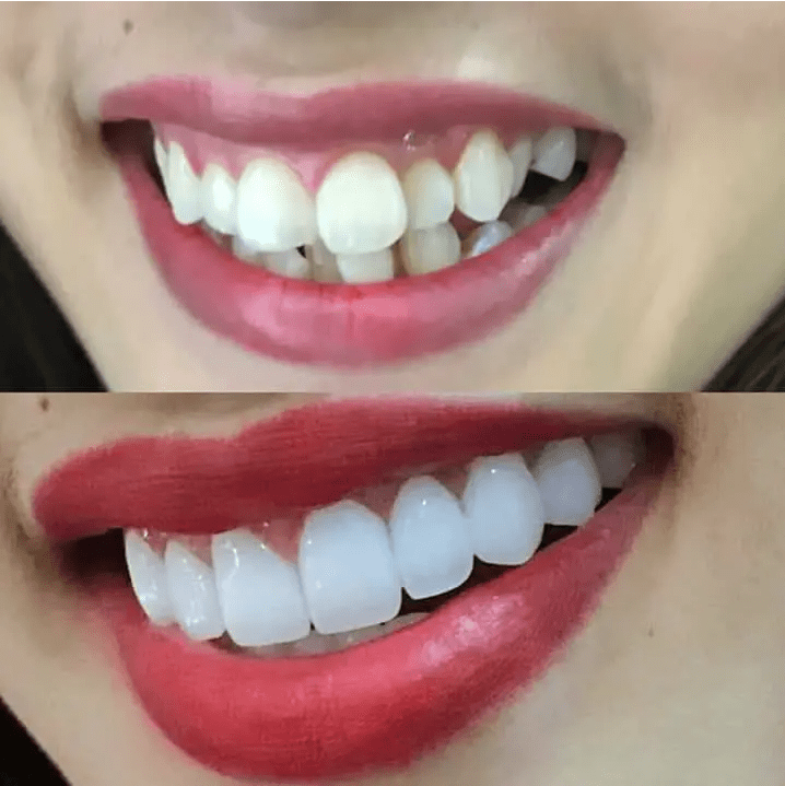 răng hô nên niềng hay bọc sứ