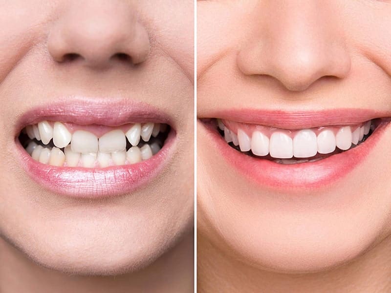 răng cửa nên bọc sứ loại nào