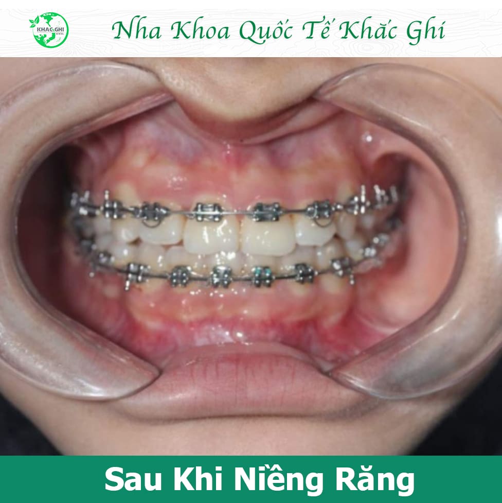 Hình ảnh sau khi niềng răng mắc cài kim loại