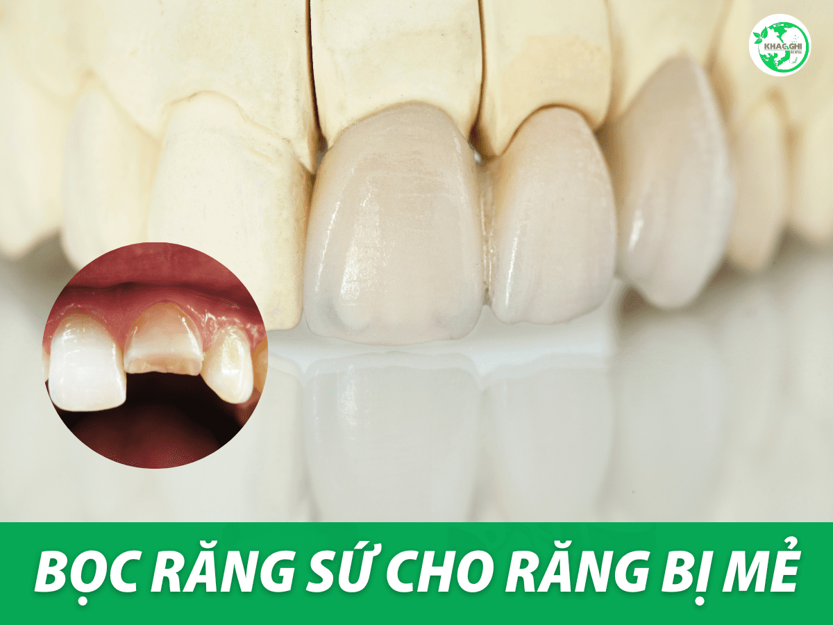 boc-rang-su-cho-rang-cua-bi-me